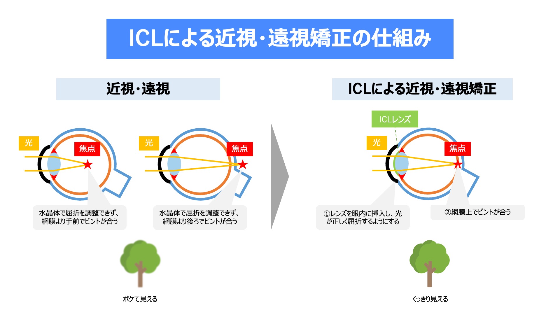 乱視：手術を受ける時期はいつですか？